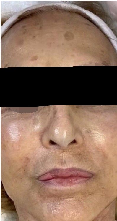 Antes - Laura, 67 años