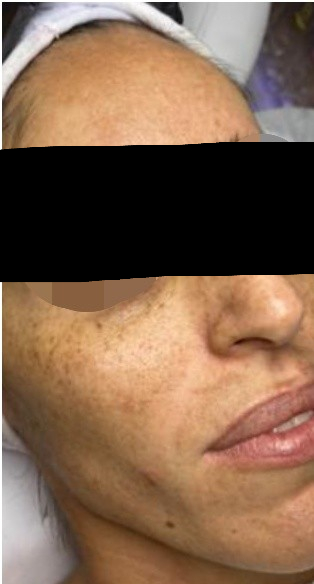 Antes - Sofía, 42 años