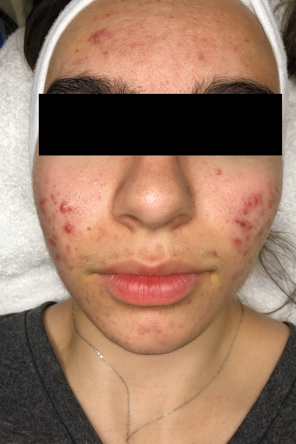 Antes - María, 28 años