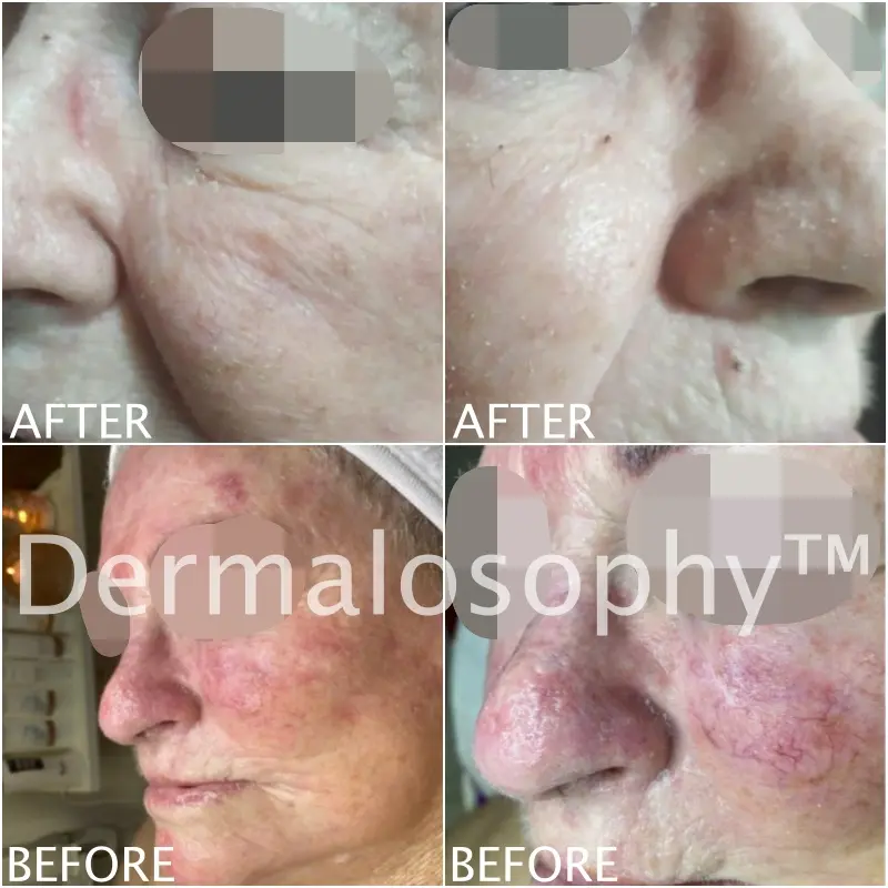 Caso de rosácea - Antes y Después