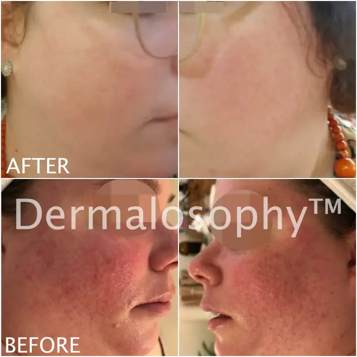 Caso de rosácea - Antes y Después